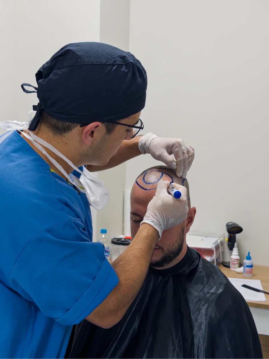 Dr. Victor Taborda realizando transplante capilar pela técnica FUE