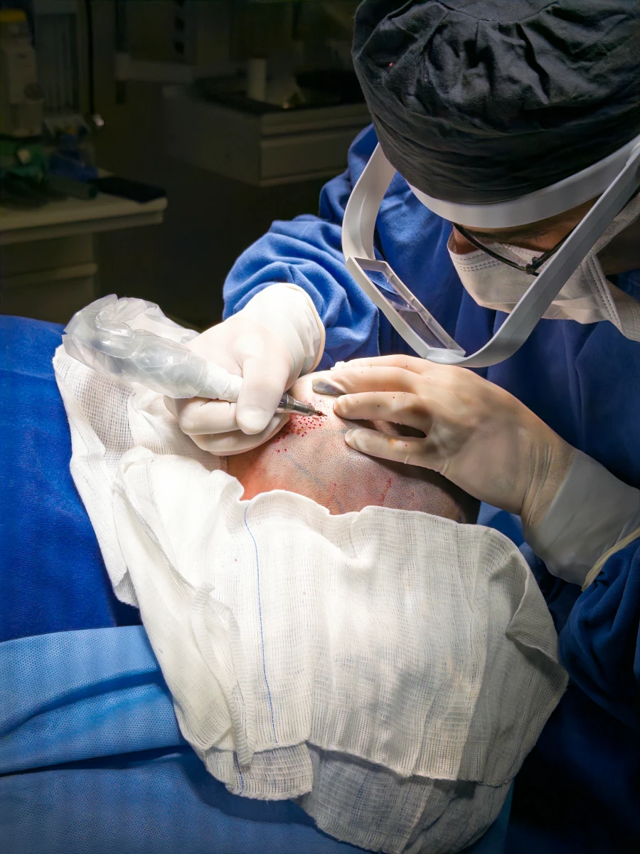 Extração dos folículos um a um pela técnica FUE durante a cirurgia de transplante capilar